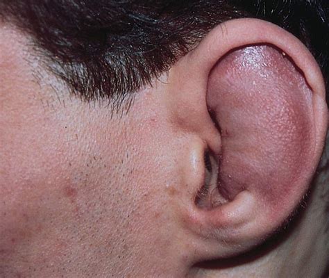 Painful Lump Behind Ear 5 Common Types Symptoms And T
