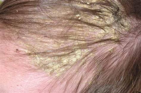 39 Awesome Rash On Back Of Head After Haircut Haircut Trends