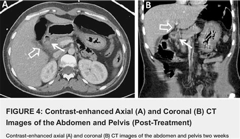 Figure 4 From Lemmel Syndrome Secondary To Duodenal Diverticulitis A