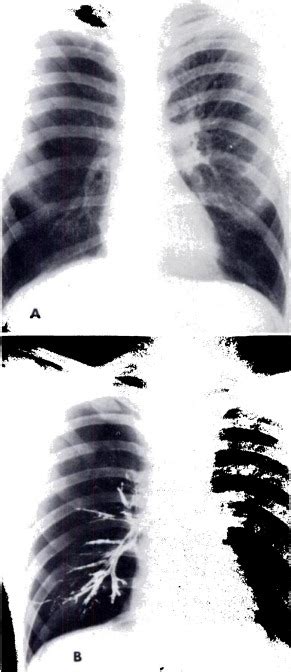 The Hyperlucent Lung A Problem In Differential Diagnosis Diseases