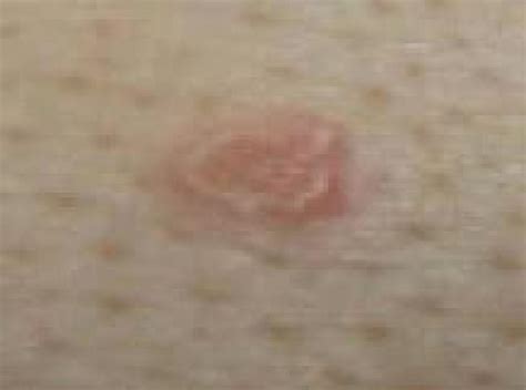 What Are The Causes Of Strawberry Skin And How To Get Rid Of It