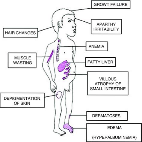 Síntomas De Kwashiorkor Personalitytipsonline