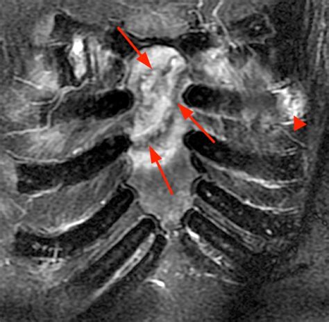 Costal Cartilage Injuries - Radsource