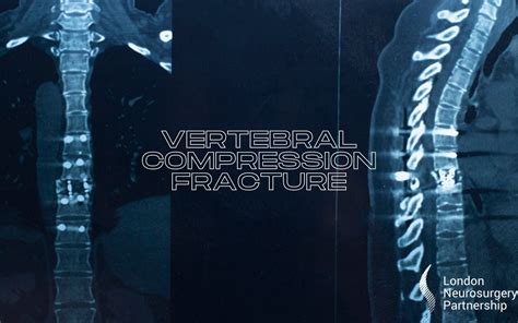 Vertebral Compression Fracture London Neurosurgery