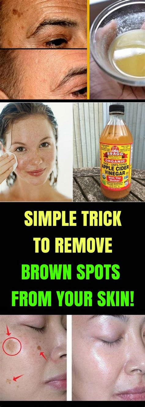 How To Get Rid Of Black Spots On Face Removebrownspotsonface In 2020