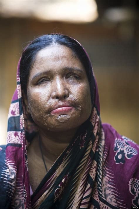 Woman Forced To Remarry Husband Who Threw Acid On Her Face After She