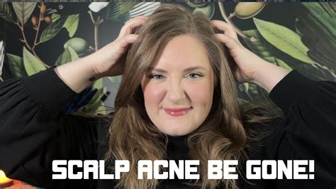 Beauty Strategy How To Manage Scalp Acne Scalp Care Tips Tricks