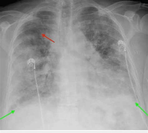 Chest X Ray Showing Ground Glass Opacity Diffuse Patchy Airspace