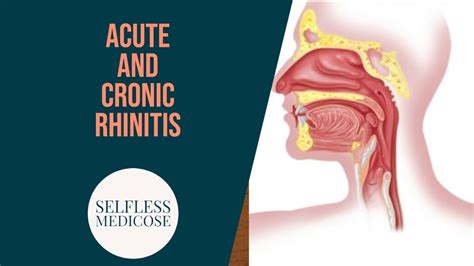 Chronic Rhinitis Part 5 Rhinitis Sicca And Rhinitis Caseosa Easy