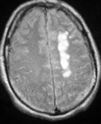 T2 Weighted Axial Brain Mri Showing A Subacute The Left Centrum Semi