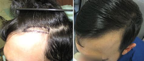 Hair Transplants By Dr Lawrence Shapiro Home