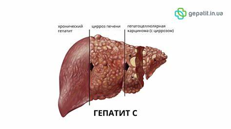 Хронический гепатит диета 5 Гепатит С — gepatit.in.ua Гепатит С — gepatit.in.ua Хронический гепатит диета 5
