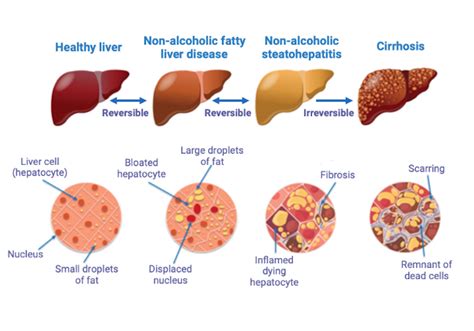Uncovering The Genetic Causes Of Fatty Liver Disease