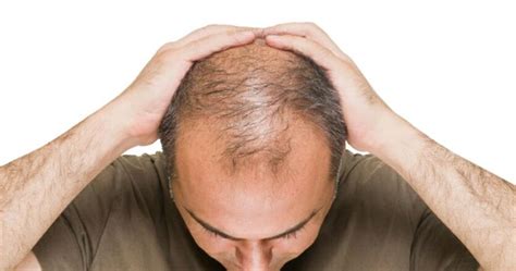 4 Ways To Stop Balding And Regrow Lost Hair 9rules Official Blog