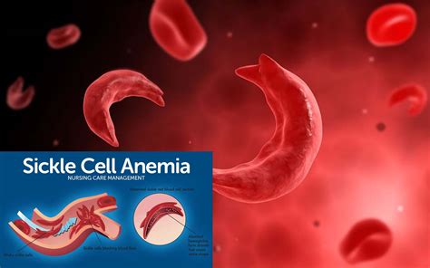 Sickle Cell Disease New Results Could Lead To New Treatments
