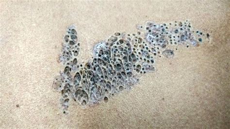 Super Blackheads Largest Blackhead Clusters And Pimple Pops Youtube