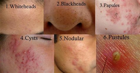 Types Of Acne Back Acne Treatment Acne Vulgaris Diy Acne Treatment