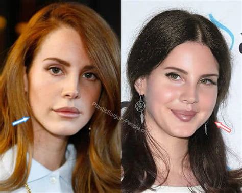 Lana Del Rey Before And After Photos Plastic Surgery