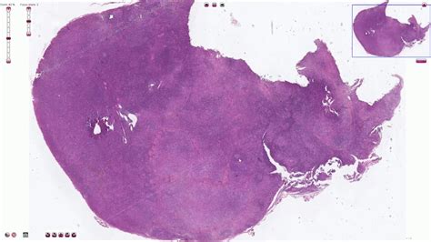 Mixed Cellularity Hodgkin Lymphoma Histopathology Youtube