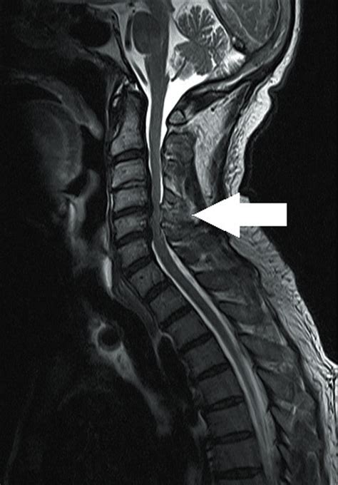Cervical Spondylotic Myelopathy Natural History And Role Of Surgery