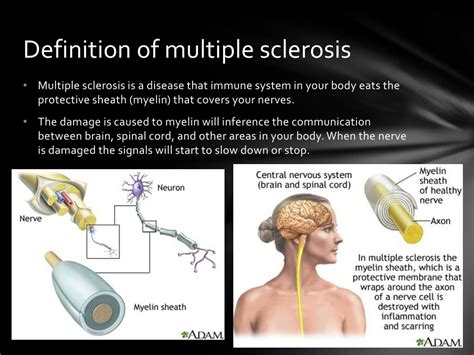Ppt Multiple Sclerosis Powerpoint Presentation Free Download Id 1867298