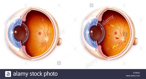 Es ist ein enzym, das blutgerinnsel auflöst. Augenblutung Stockfotos & Augenblutung Bilder - Alamy