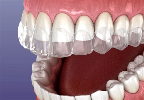 Contenção dentária Tipos finalidade como funciona custo