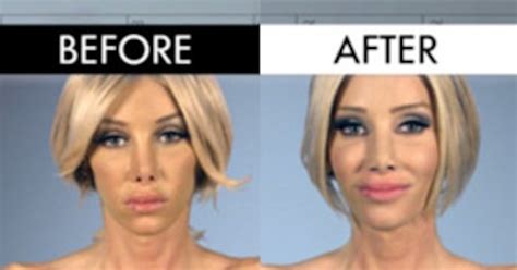 See The Mind Blowing Before And After Pics Of Botched Patients E News Australia