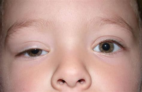 Droopy Eyelids Ptosis Pediatric Ophthalmology Pa