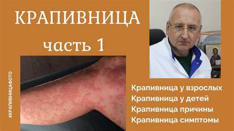 Крапивница. Крапивница у взрослых. Крапивница у детей. Крапивница фото Картинка - Крапивница. Крапивница у взрослых. Крапивница у детей. Крапивница фото