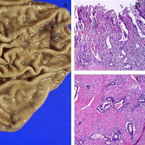 Gastric Carcinoma Morphologic Classifications And Molecular Changes