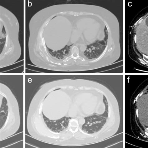 Chest Computed Tomography Hrct Of The Lung Before A B C And After