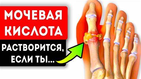 Диета подагра повышена мочевая кислота Мочевая кислота перестала грызть суставы, после того как... Подагра и Мочевая кислота перестала грызть суставы, после того как... Подагра и Диета подагра повышена мочевая кислота