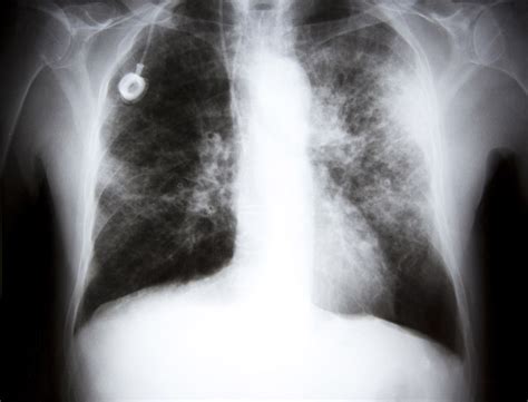 The lifespan of a dog with malignant cancer is not predictable. Asbestos Lung Cancer: Causes, Diagnosis & Treatment