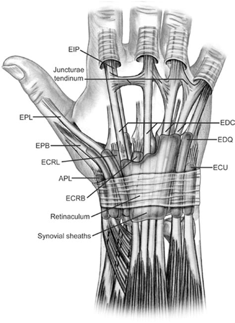 Sagittal Band Rupture Traumatic Extensor Tendon Dislocation Hand