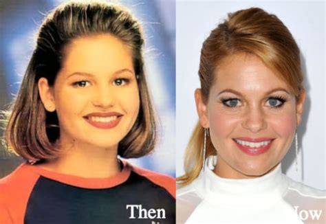 Candace Cameron Plastic Surgery Before And After Photos Latest