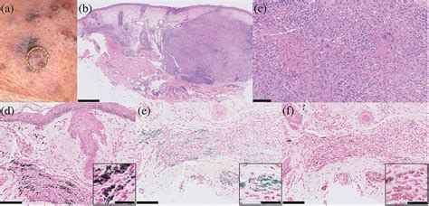 Minocycline Induced Hyperpigmentation Confined To Lupus Miliaris