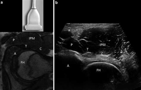 Ultrasound Of The Hip Musculoskeletal Key