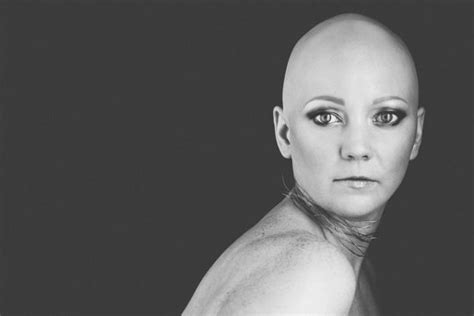 Celebrating Alopecia Hair Loss Women Alopecia Pattern Baldness