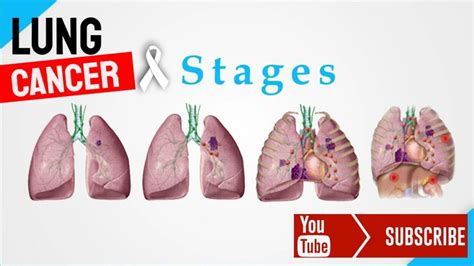 the different stages of lung cancer male health clinic