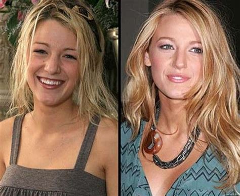 Blake Lively Nose Job Sad That So Many Hollywood Actresses Feel The Need To Correct So Much