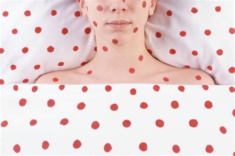 Chicken Pox And Shingles 5 Things We Should Know About The Infections