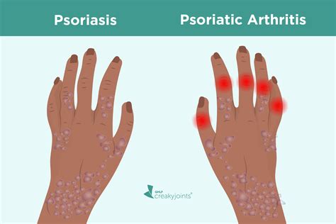 BIPOC Patient Voices Living With Psoriasis And Psoriatic Arthritis GHLF Org