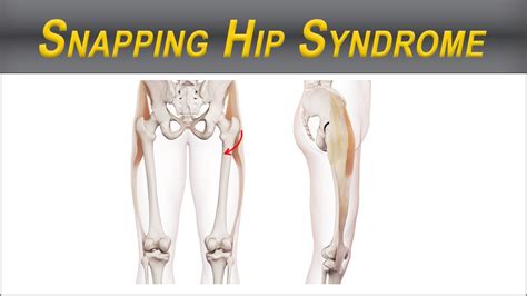 Get Rid Of Snapping Hip Syndrome Iliotibial Band Tightness Strength