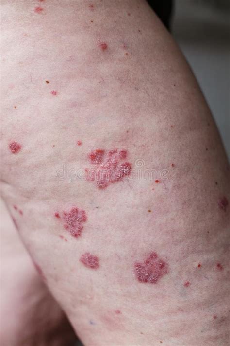 Close Up Ill Allergic Rash Eczema Skin Of Patient Atopic Dermatitis