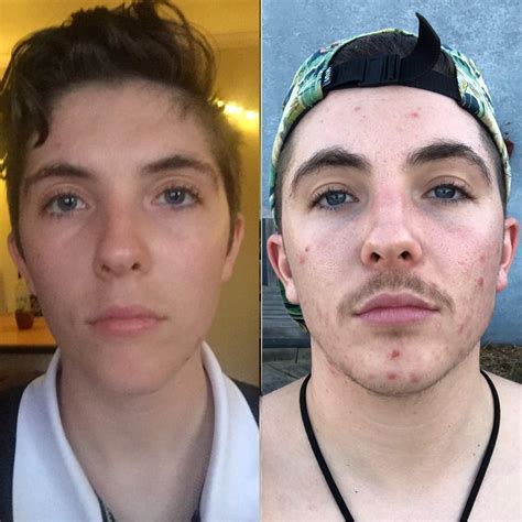 1 Day Before Testosterone 1 Year On Testosterone And Living For It Henny Transtimelines