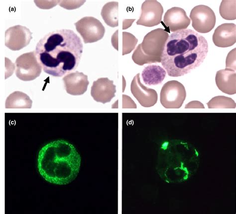 Peripheral Blood Films In Myh9 Related Disease Evaluation Platelet And