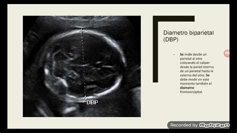 Biometria Fetal Dbp O Que Significa
