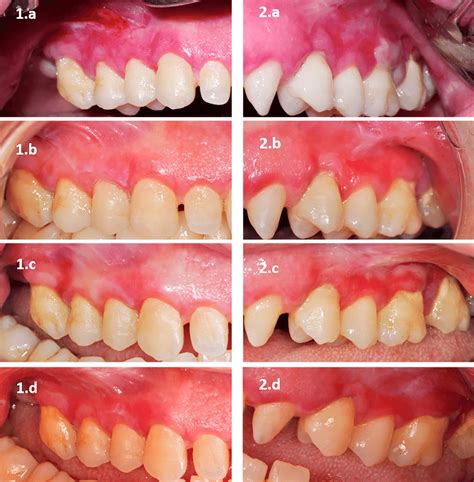 The Picture Comparing Injectable Platelet Rich Fibrin I Prf And