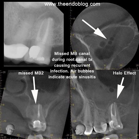 Cbct To Identify Odontogenic Sources Of Maxillary Sinusitis The Endo